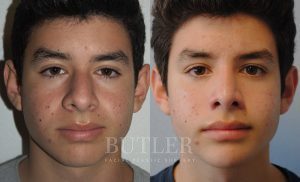 Rhinoplasty Before and After Patient Thumbnail 1