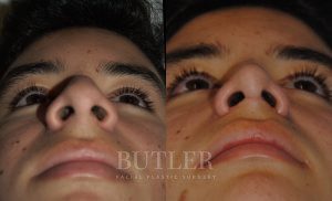 Rhinoplasty Before and After Patient Thumbnail 2