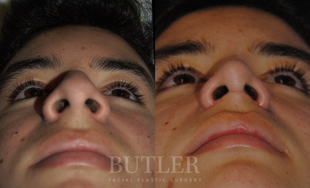 Rhinoplasty Before and After Patient 2
