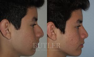 Rhinoplasty Before and After Patient Thumbnail 4