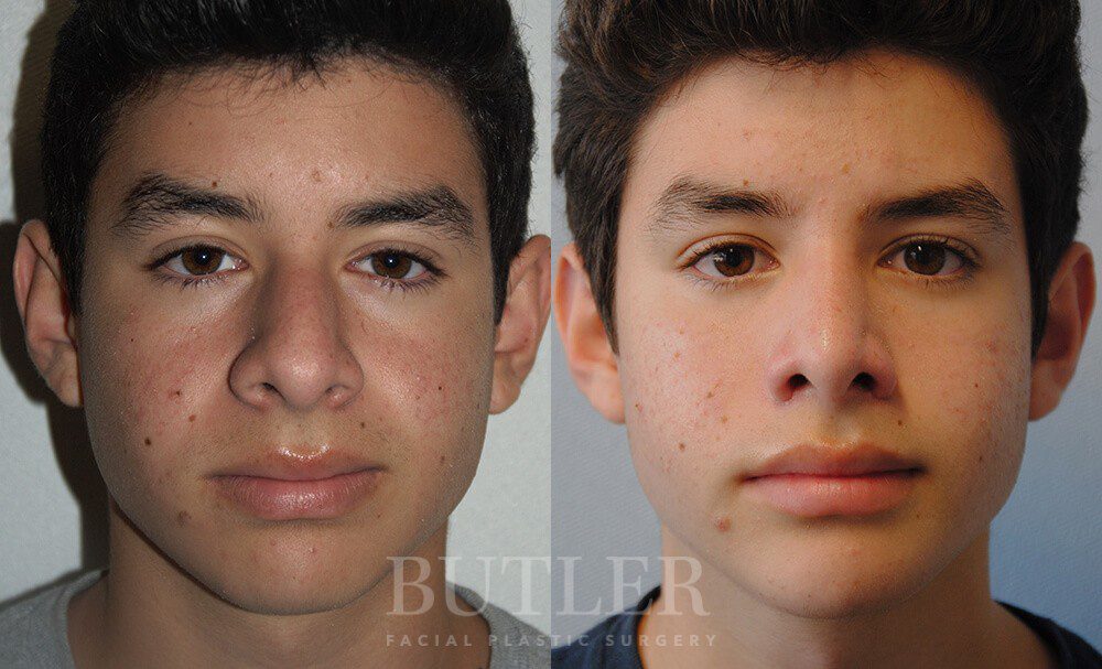 Rhinoplasty Before and After Patient 1