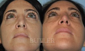 Revision Rhinoplasty Before and After Patient Thumbnail 2