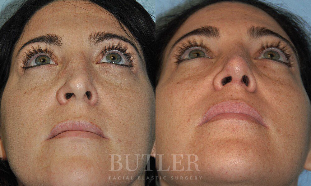 Revision Rhinoplasty Before and After Patient 2