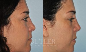 Revision Rhinoplasty Before and After Patient Thumbnail 4