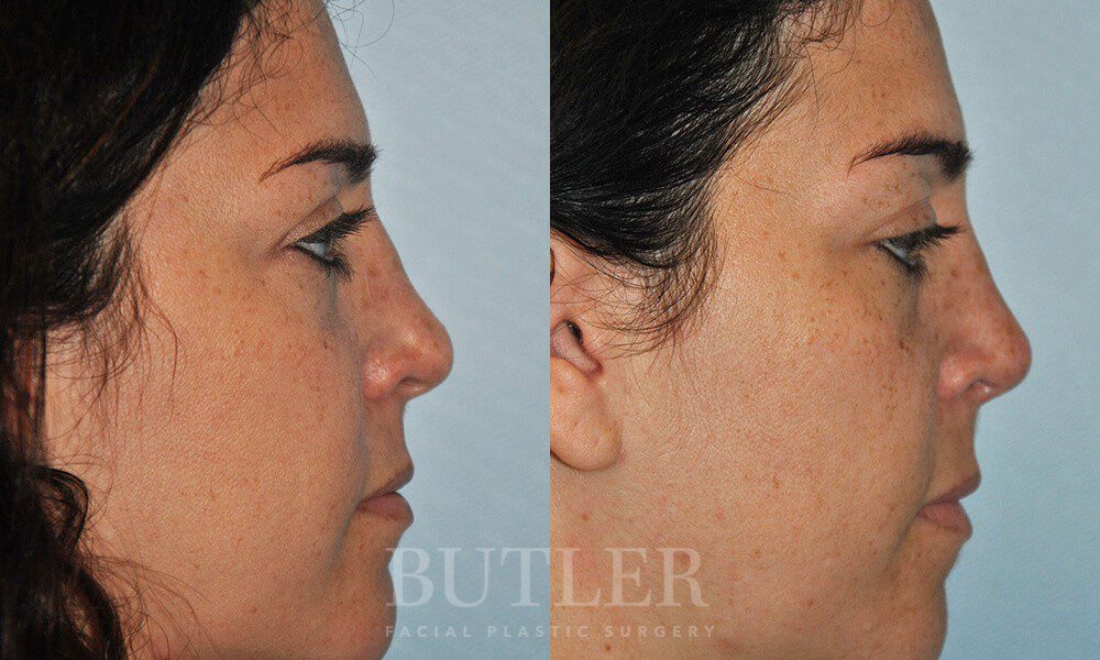Revision Rhinoplasty Before and After Patient 4