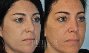 Revision Rhinoplasty Before and After Patient Thumbnail 3