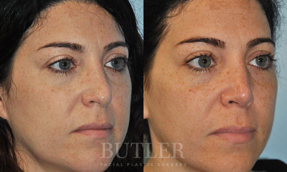 Revision Rhinoplasty Before and After Patient 3