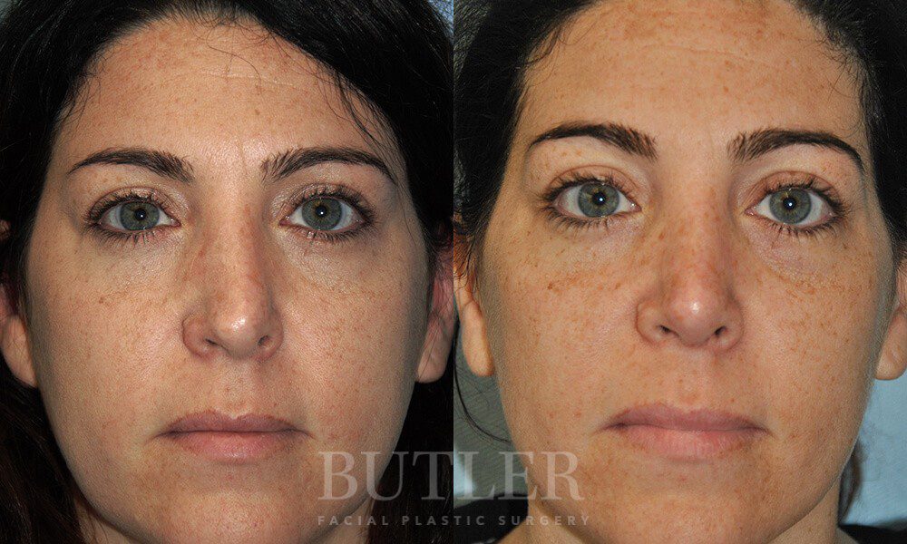 Revision Rhinoplasty Before and After Patient 1