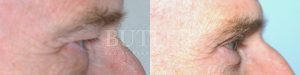 Brow Lift Before and After Patient Thumbnail 2