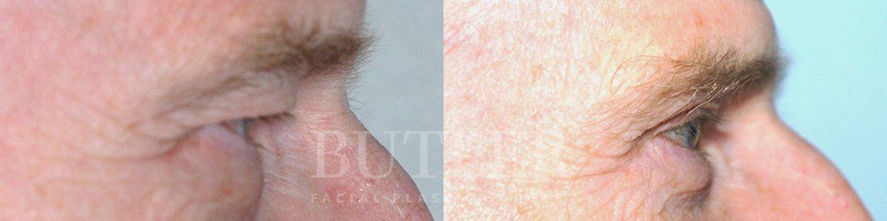 Brow Lift Before and After Patient 2