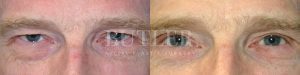 Brow Lift Before and After Patient Thumbnail 1
