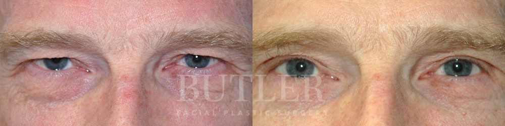 Brow Lift Before and After Patient 1