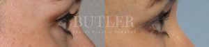 Blepharoplasty Before and After Patient Thumbnail 2