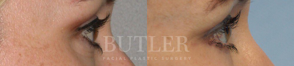 Blepharoplasty Before and After Patient 2