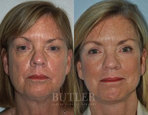 Facelift Before and After Patient Thumbnail 1