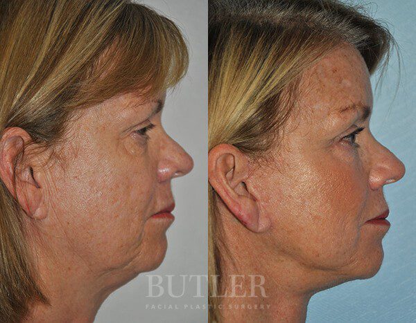 Facelift Before and After Patient 3