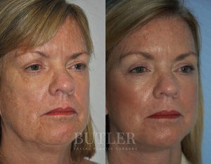 Facelift Before and After Patient Thumbnail 2
