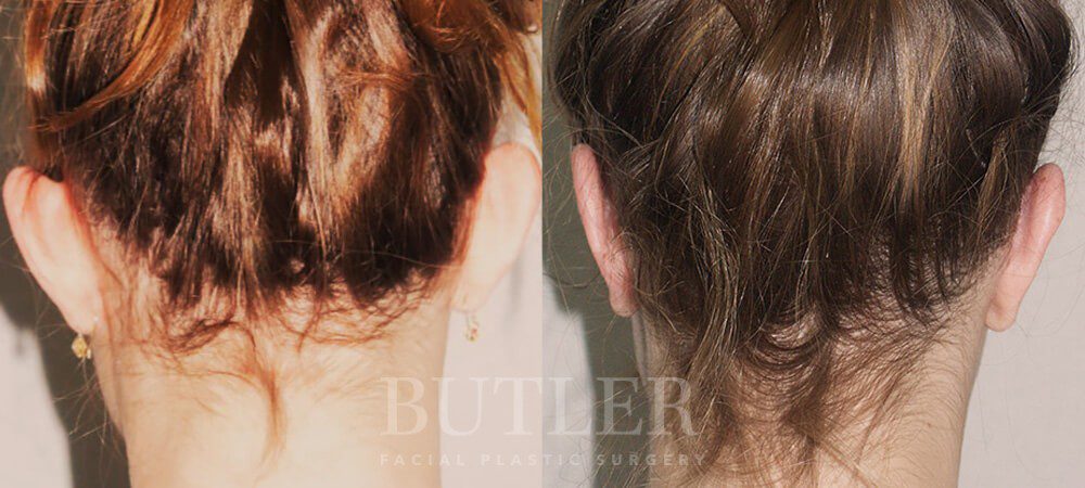 Otoplasty Before and After Patient 5