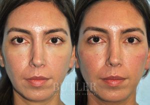 Cheek Enhancement Before and After Patient Thumbnail 1