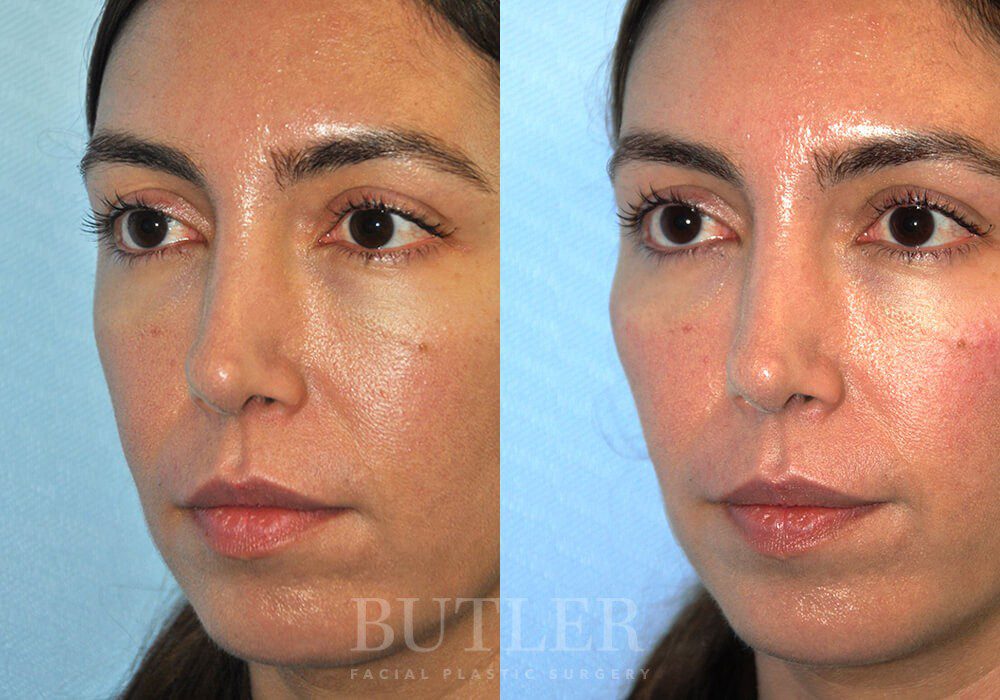 Cheek Enhancement Before and After Patient 2