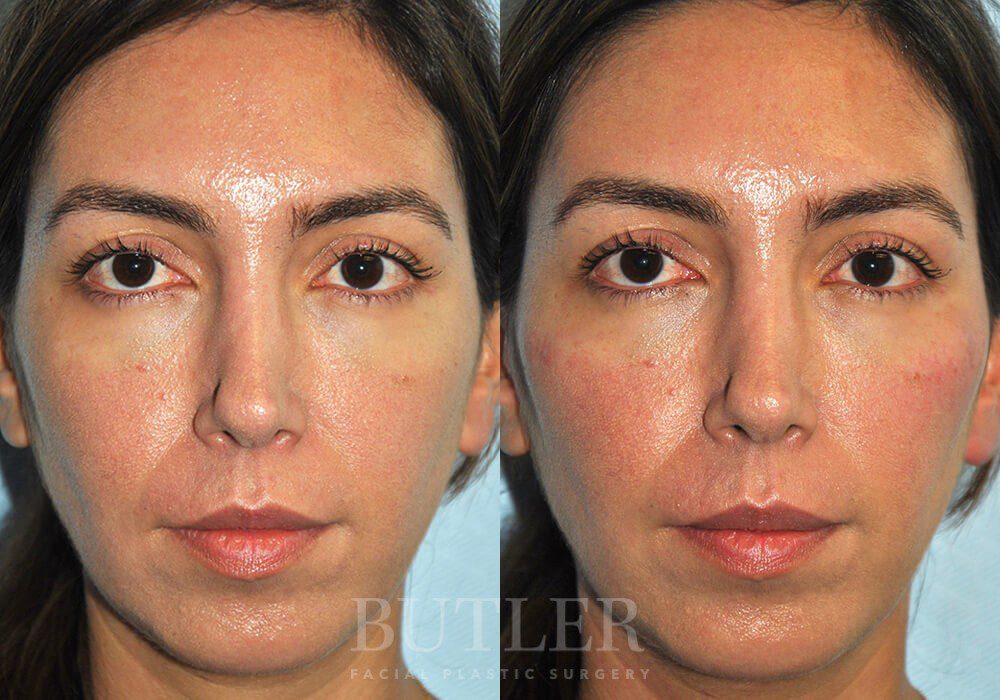 Cheek Enhancement Before and After Patient 1