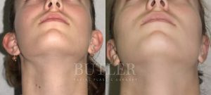 Otoplasty Before and After Patient Thumbnail 2
