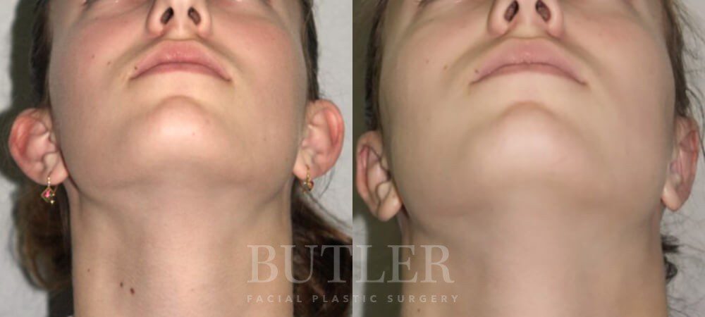Otoplasty Before and After Patient 2