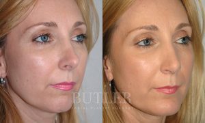 Revision Rhinoplasty Before and After Patient Thumbnail 3