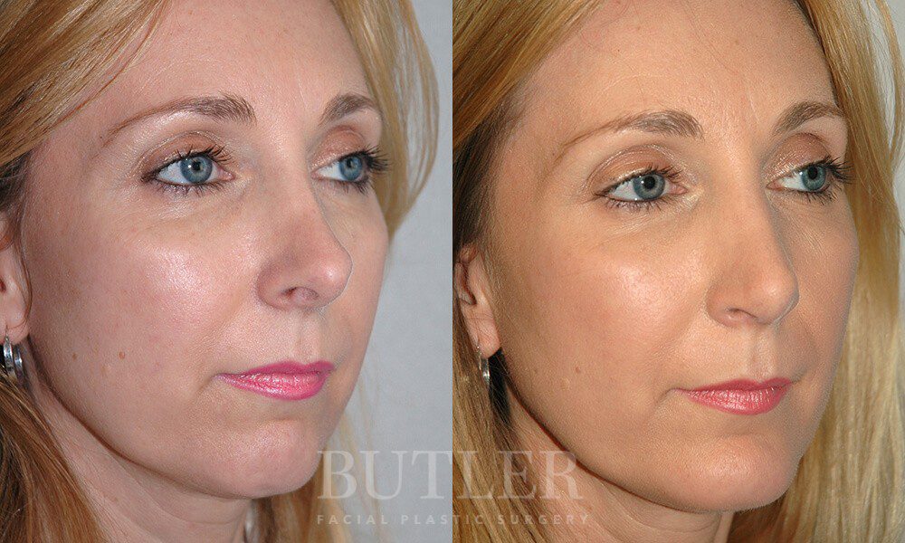 Revision Rhinoplasty Before and After Patient 3