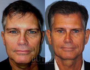 Facelift Before and After Patient Thumbnail 1