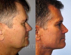 Facelift Before and After Patient Thumbnail 3