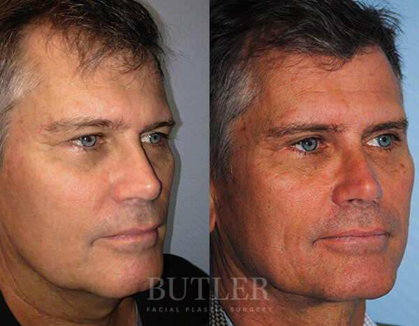 Facelift Before and After Patient 2