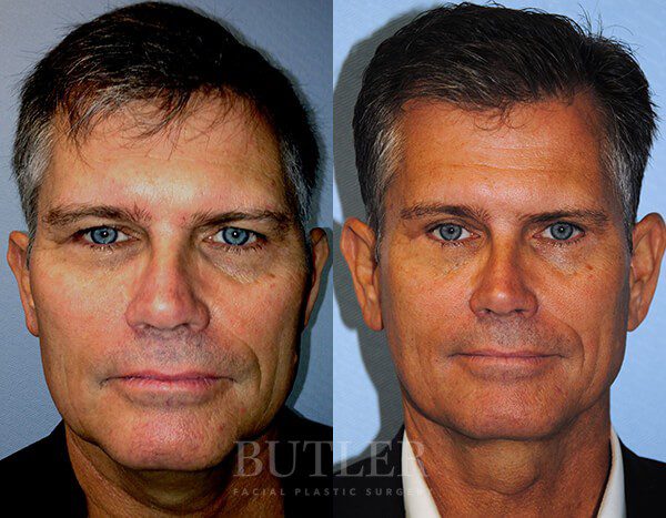 Facelift Before and After Patient 1