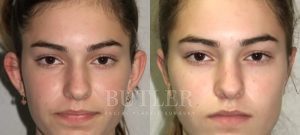 Otoplasty Before and After Patient Thumbnail 1