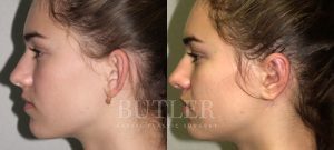 Otoplasty Before and After Patient Thumbnail 4