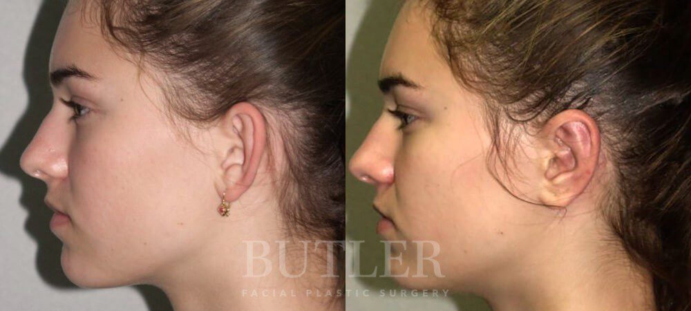 Otoplasty Before and After Patient 4