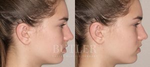 Otoplasty Before and After Patient Thumbnail 3