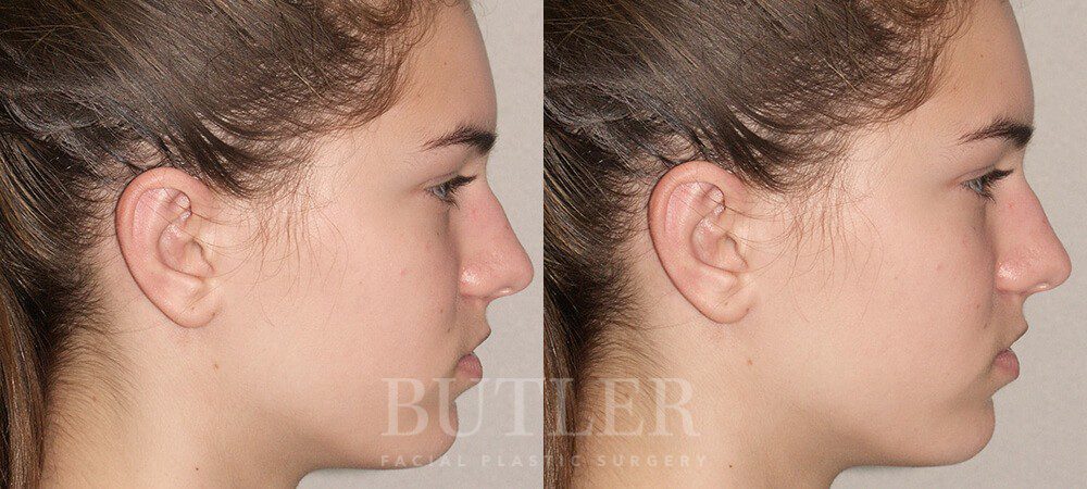Otoplasty Before and After Patient 3