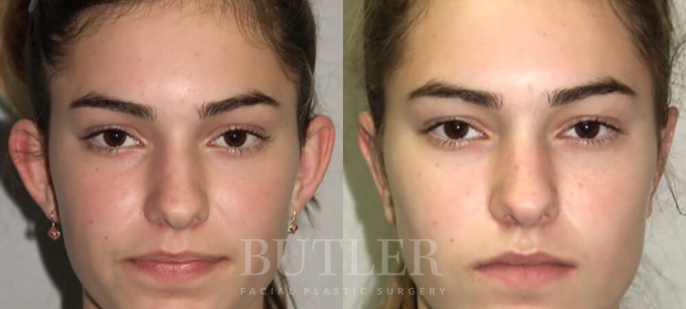Otoplasty Before and After Patient 1