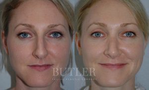 Rhinoplasty Before and After Patient Thumbnail 1