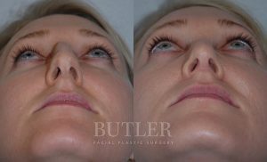 Rhinoplasty Before and After Patient Thumbnail 2