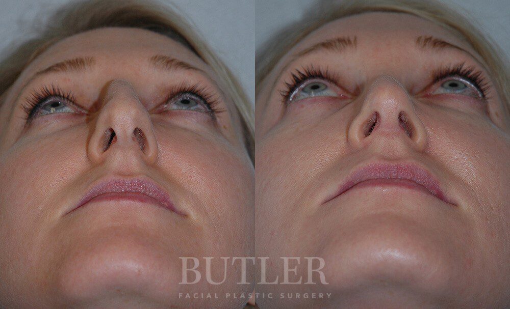 Rhinoplasty Before and After Patient 2