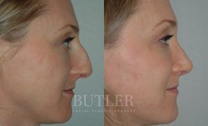 Rhinoplasty Before and After Patient Thumbnail 4
