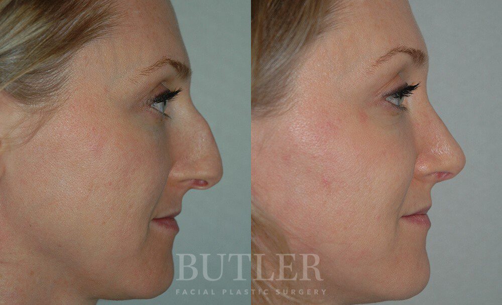 Rhinoplasty Before and After Patient 4