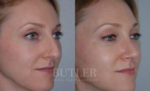 Rhinoplasty Before and After Patient Thumbnail 3