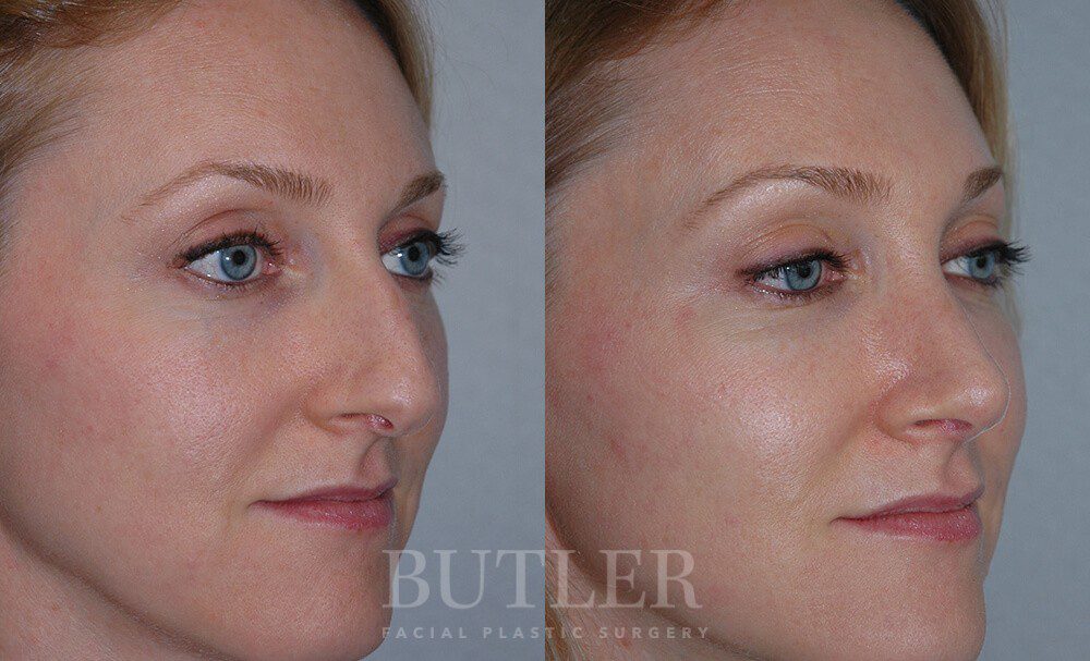 Rhinoplasty Before and After Patient 3