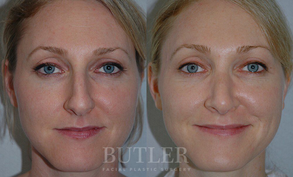 Rhinoplasty Before and After Patient 1