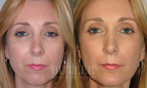 Revision Rhinoplasty Before and After Patient Thumbnail 1