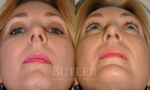 Revision Rhinoplasty Before and After Patient Thumbnail 2
