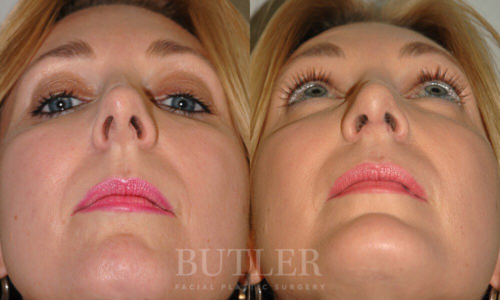 Revision Rhinoplasty Before and After Patient 2